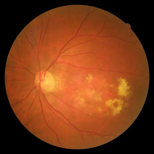 Diyabetik Retinopati
