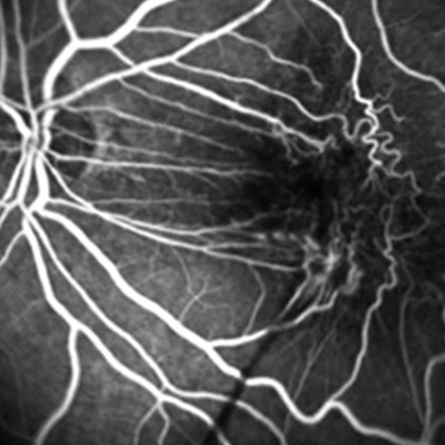 Epiretinal Membran