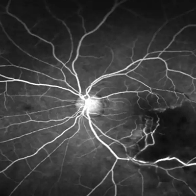 Fundus Floresein Anjiografisi (FFA)