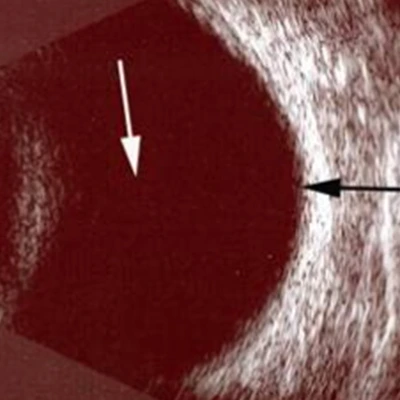 Oftalmik Ultrasonografi (USG)
