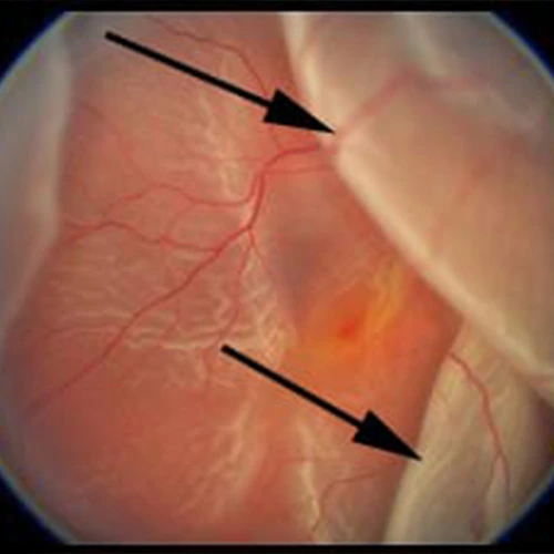 Retina Dekolmanı