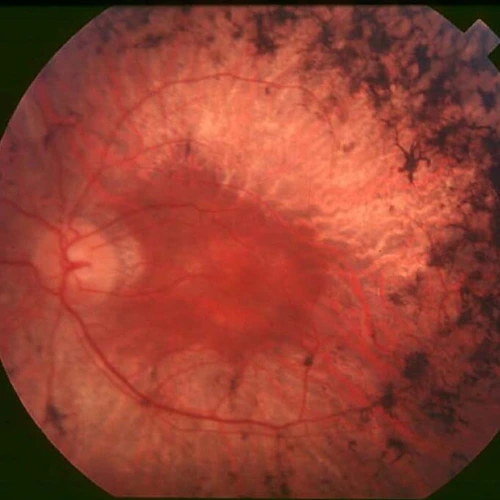 Retinitis Pigmentosa (Gece Körlüğü)