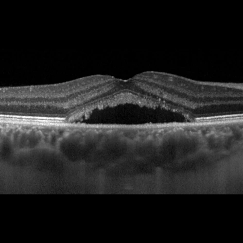 Santral Seröz Retinopati
